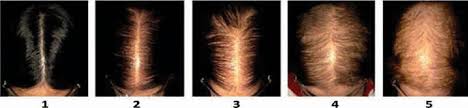 Pcos hair loss starts with hair thinning, especially at the frontal and the vertex (middle) region of the scalp. Alopecia In General Medicine Rcp Journals