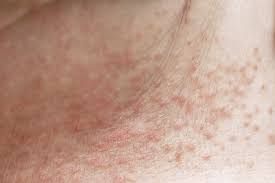 Image result for heat rash under breasts