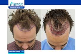 مراحل نمو الشعر المزروع مراحل زراعة الشعر مراحل نمو الشعر بعد الزراعة نمو الشعر المزروع