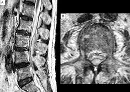 Image result for Spinal Epidural Abscess