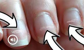 Pourquoi Des Taches Blanches Apparaissent Sur Les Ongles