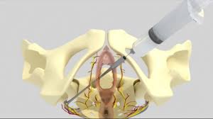 Image result for Pudendal Block