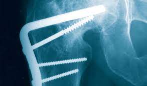 Saat kuelus punggungnya, tante yana mendongakkan kepalanya dan terengah. Sambung Tulang Patah