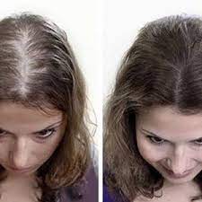 Sac Ekimi Fiyatlari Kadinlarda Sac Ekimi Ve Sac Ekimi Sonrasi Hair Cure Natural Hair Styles Dyed Hair