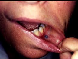 Your tongue has lots of nerve endings, so it can really hurt if you bite or injure it. Amalgam Tattoo Dermnet Nz