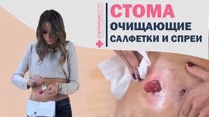 Check spelling or type a new query. Kakimi Byvayut Kishechnye Stomy I Chto Takoe Urostoma