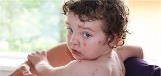 Bei negativem ergebnis einer serumuntersuchung auf eine durchgemachte windpocken erkrankung: 15 Jahre Varizellen Impfung Segen Fur Kinder Und Familien