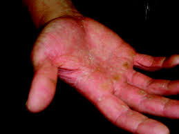 For severe eczema or as an occasional treatment for intense itch, add another step after your bath. Hand Dermatitis Review Of Etiology Diagnosis And Treatment American Board Of Family Medicine