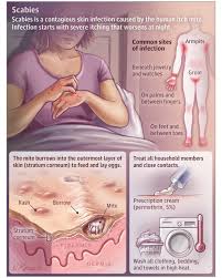 Image result for scabies human symptoms
