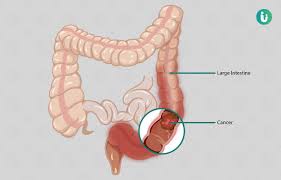 Because symptoms often do not appear until the cancer has to understand colorectal cancer, it is helpful to understand what parts of the body are affected and how they work. Colon Cancer Symptoms Causes Treatment Doctor Medicine Prevention Diagnosis