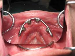 How Many Dental Implants Do I Need Under My Denture?