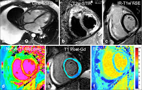 Myocarditis is an inflammation of the heart muscle (myocardium). Lights And Shadows Of Cardiac Magnetic Resonance Imaging In Acute Myocarditis Insights Into Imaging Full Text
