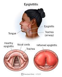 Image result for Acute Laryngitis