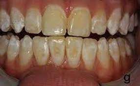 How To Get Fluoride Off Of My Teeth After Coming From The Dentist Quora