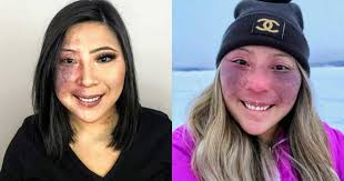 How could any guy be interested in me? I'd stare in the mirror, disgusted  and wondering, 'Why me?' Makeup became my security blanket.': Woman with  Port Wine Stain, Blue Nevus urges 'self-love