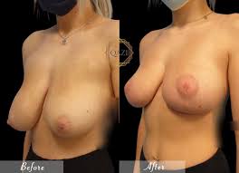 Breast Lift | Surgical Breast Lift | Qazi Cosmetic Center & MedSpa