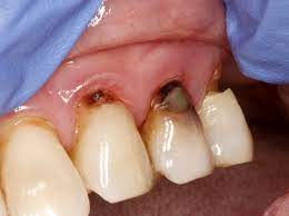 How much does it cost to fix a front tooth cavity? Tooth Decay On The Root Surface Mccarl Dental Group