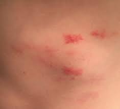 Image result for mite bites on humans