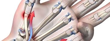 Aug 07, 2021 · fantasy football 247 is a site dedicated to providing fpl managers with team news, reviews, transfer tips, captain picks and advice from the premier league Tendon Rupture Following Trigger Finger Release Medmovie Com