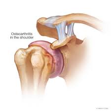 Maybe you would like to learn more about one of these? Shoulder Cartilage And Arthritis Mayo Clinic Orthopedics Sports Medicine
