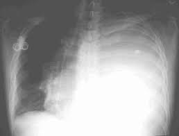 Image result for Thoracentesis