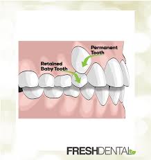 Image result for Tooth Extraction