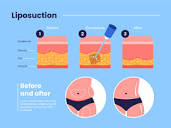 What Is Ultrasonic Liposuction?