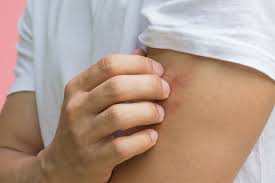 Image result for große winkelspinne biss haut reaktion