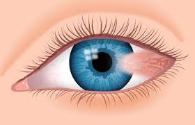 Goz Eti Pterjium Universal Goz Hastanesi