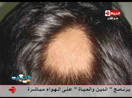 العيادة د سالي صفوت استشاري الأمراض الجلدية بالصور شكل الثعلبة عند الأطفال The Clinic Youtube