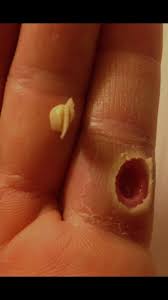 There are many guidelines and tools available on this site to. Nice Gaping Hole In Finger Trypophobia