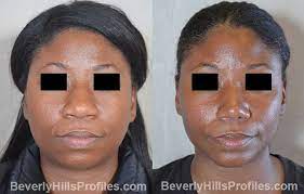 Dealsnow is the newest place to search. Rhinoplasty Before After Photos At Beverly Hills Profiles