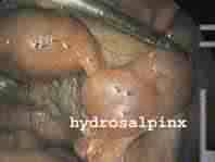 एन्क्रिप्शन के उदहारण | examples of encryption in hindi. Fallopian Tube Testing Diagnosis And Treatment Of Tubal Disease Hsg And Sonosalpingogram