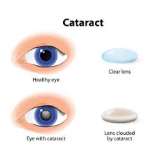 It's always a great experience at klahanie eye care. Eye Care Centre Near Me Best Eye Care Treatment Dr Monica S Eye Clinic