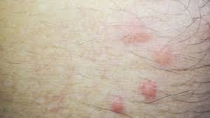 Fleabites Symptoms And Treatments