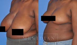 Check spelling or type a new query. Breast Reduction Austin Meridian Plastic Surgery