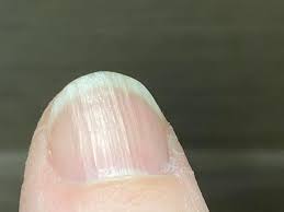 What causes ridges on fingernails and how to treat them?