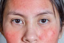Mengetahui penyebab kulit kepala perih tidak hanya akan meredakan rasa perih, tetapi juga membuka pintu menuju rambut yang tampak lebih sehat. Beauty Journal Situs Kecantikan Dan Gaya Hidup Andalan Wanita Masa Kini