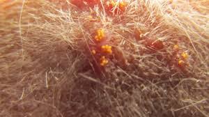 Image result for Trombicula autumnalis bites