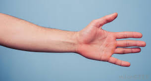 Certain medications may also cause red palms, especially in people with impaired liver function. What Is Palmar Erythema With Pictures