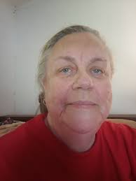 Prayer Request for Successful Eye Surgery