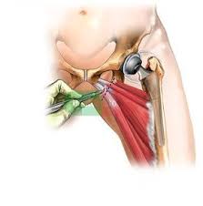 The iliopsoas muscle is a major mover of your hip joint. Adductor Muscles Of The Hip Of The Adductor Muscle Tendons Following A Total Left Hip Replacement Hip Anatomy Hip Replacement Hip Replacement Surgery