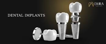 Dental implants - عيادات ديورا