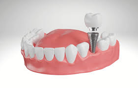 Dental Implants Langley | Dental Implants Near You