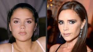 7 horas despues del resultado de la cirujia de la bichectomia cualquier informacion para que se la quieran realizar contacten facebook dental urano. Bolas De Bichat O El Secreto De Las Famosas Para Adelgazar Su Rostro