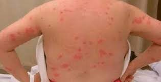Spider bites are rarely a serious health threat, but knowing the kind of spider that bit you can help you get the right treatment. Human Skin Mite Bites Novocom Top
