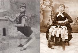 Ella Harper & Myrtle Corbin - More Than a Curiosity — Disability Throughout  History
