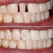 Peg Lateral Fixed With Bonding Orthodontics Treats Cosmetic Dentistry