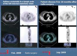 (1) gary ulaner, md, phd, facnm. 18f Fdg Pet Ct In Patients With Breast Cancer And Rising Ca 15 3 With Negative Conventional Imaging A Multicentre Study European Journal Of Radiology
