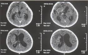 Tuberculoza Elemente Generale Pdf Dwrean Lhpsh